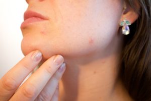  Blog 71 Tips for a Woman With Acne