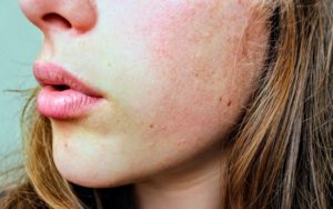 Blog 72 Pregnancy Acne